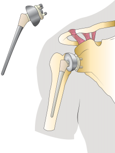 Total Shoulder Arthroplasty Coding Riddle: Lesser Tuberosity Osteotomy